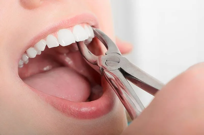 How Long Does Bleeding Last After Tooth Extraction